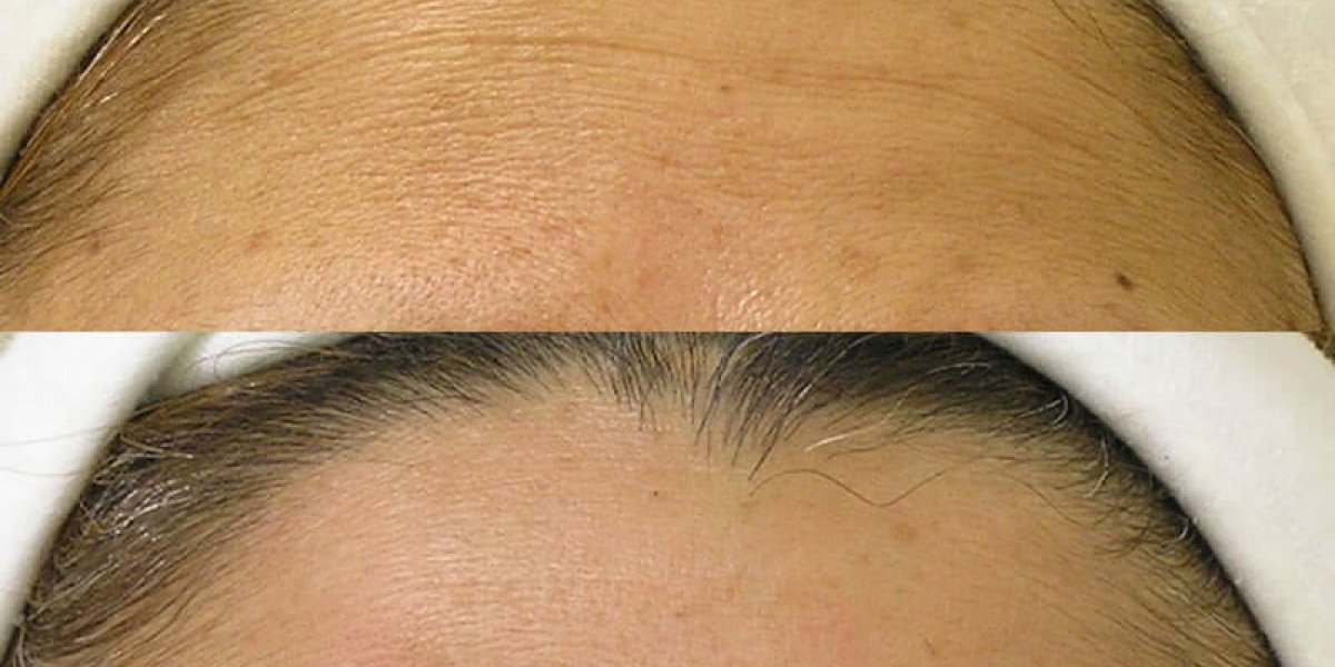 HydraFacial for Oily Skin: Help or Make It Worse?